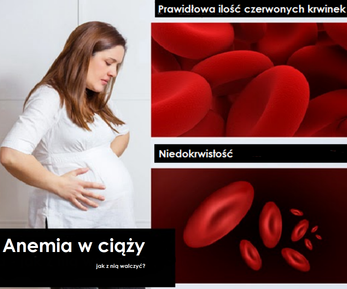 Anemia W Ciąży Przyczyny Objawy I Leczenie E Szkrabpl 1362